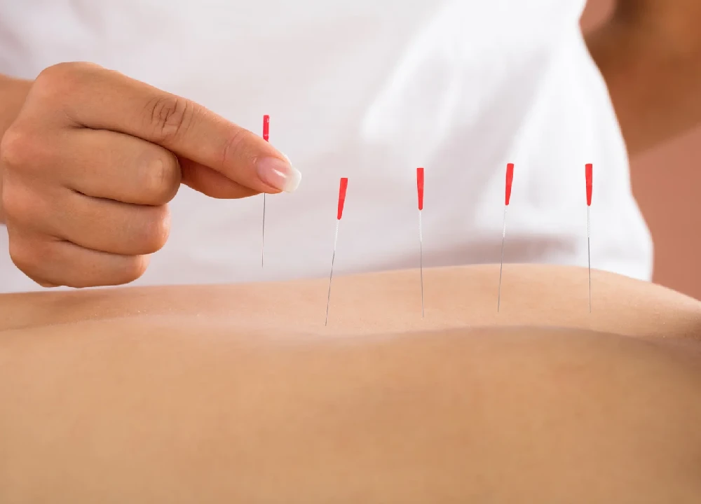 acupuncture