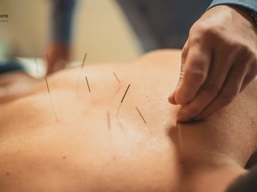Acupuncture Treatment