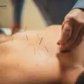 Qué Funciona en la Acupuntura para el Dolor de Espalda en Guaymas, Sonora